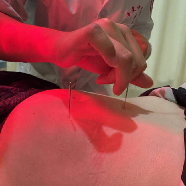 Acupuncture treatment with Dr. Yang