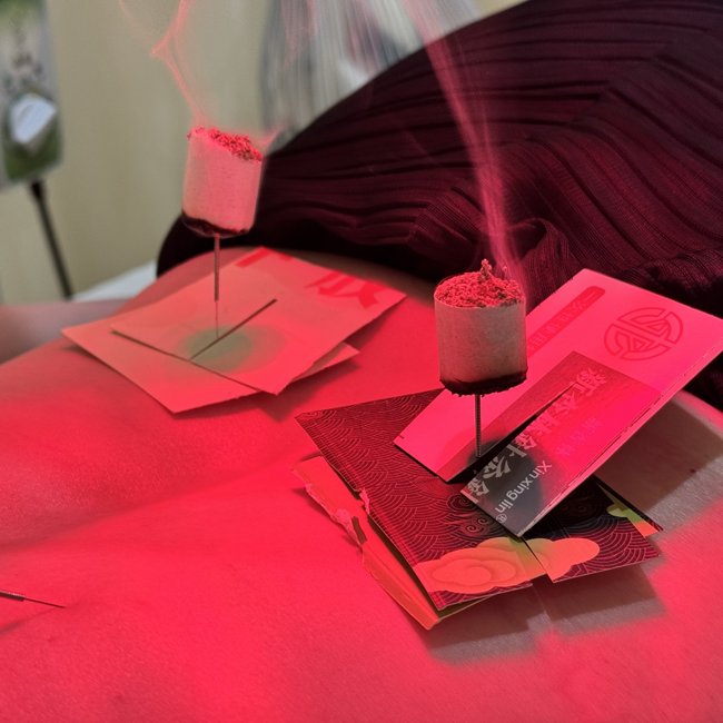 Moxibustion (moxa) therapy