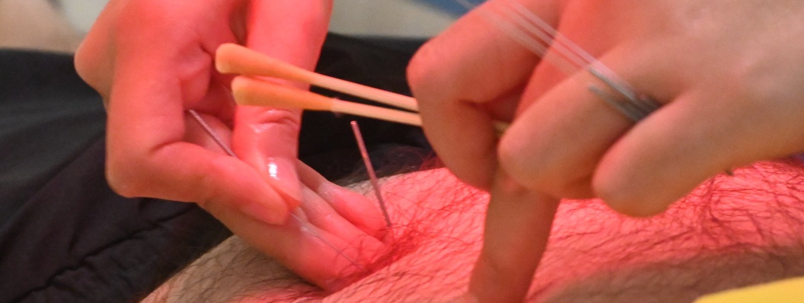 Acupuncture needles being placed during treatment in Kunming
