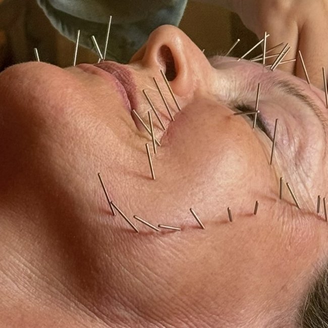 Facial cosmetic acupuncture treatment